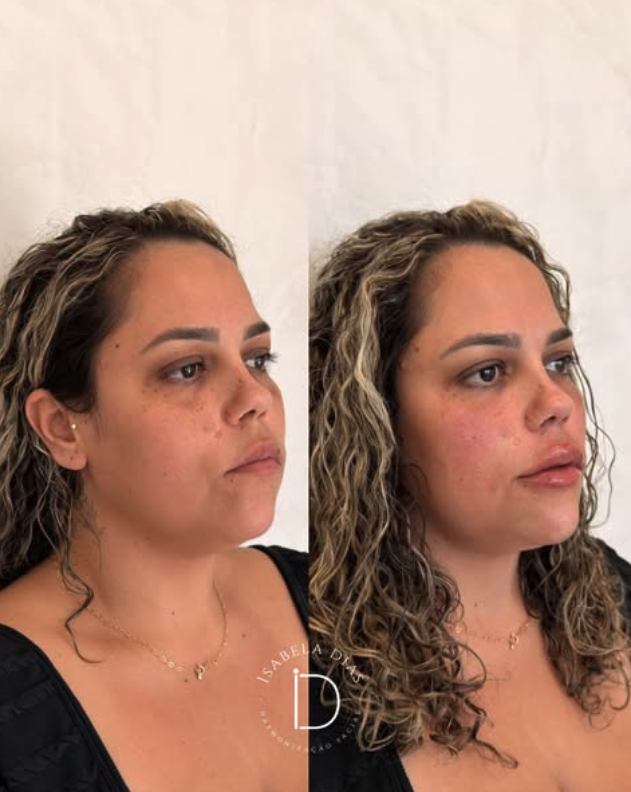 resultado harmonização