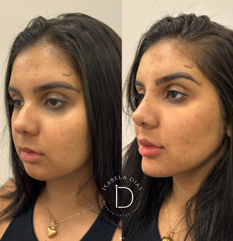 resultado facial